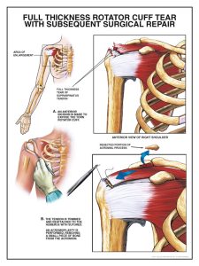 Rotator_cuff_high-225x300